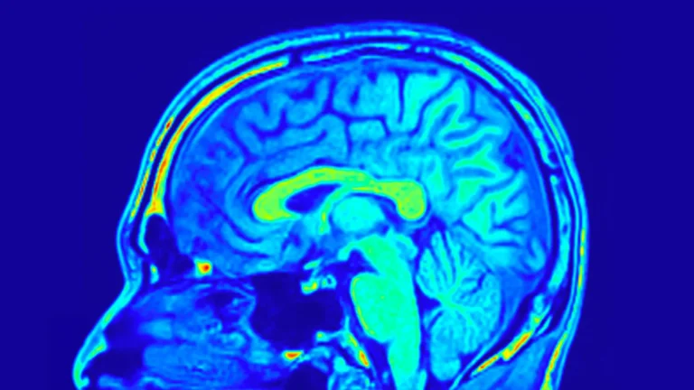 تصویر اسکن MRI مغز انسان برای پیش‌بینی و درمان شخصی‌سازی‌شده افسردگی