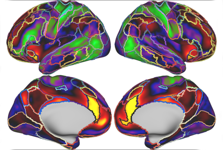 بررسی شبکه برجستگی مغز در افسردگی با اسکن fMRI
