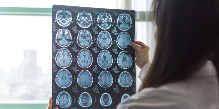 بررسی تغییرات ساختاری قشر مغز و اسکن MRI در تشخیص زودهنگام آلزایمر